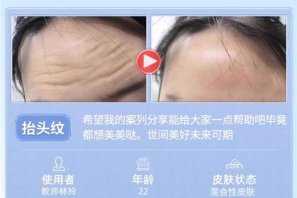 教你几招轻松击退额头八字纹，恢复平滑额头